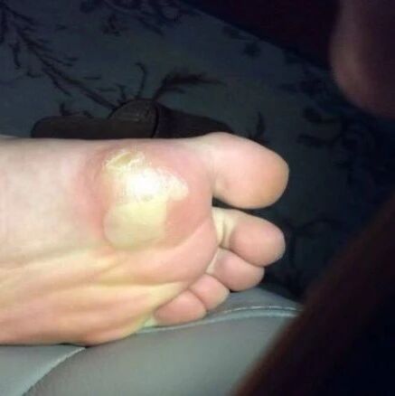 Why do blisters form on the soles of your feet when playing badminton? 90% of cases are linked to these 3 reasons.